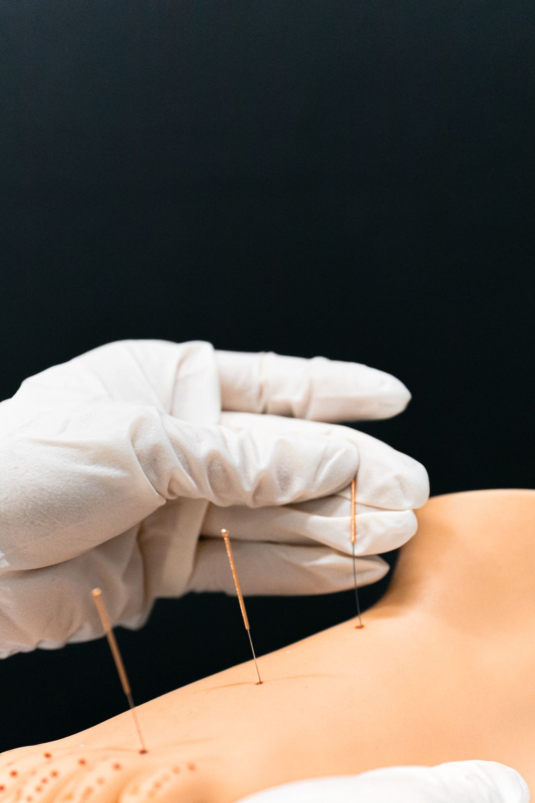 Agulhas de acupuntura aplicadas na pele em tratamento de bem-estar